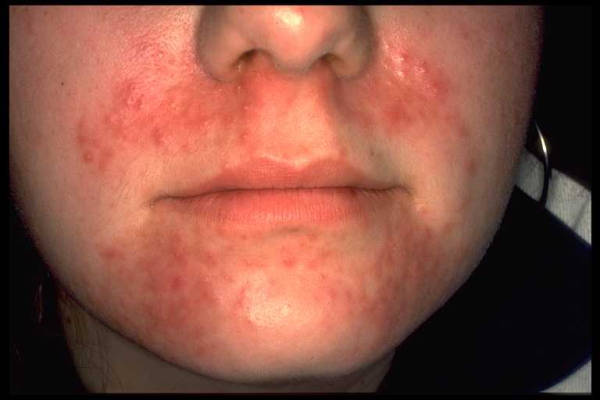 DermIS - Perioral Dermatitis (information on the diagnosis)